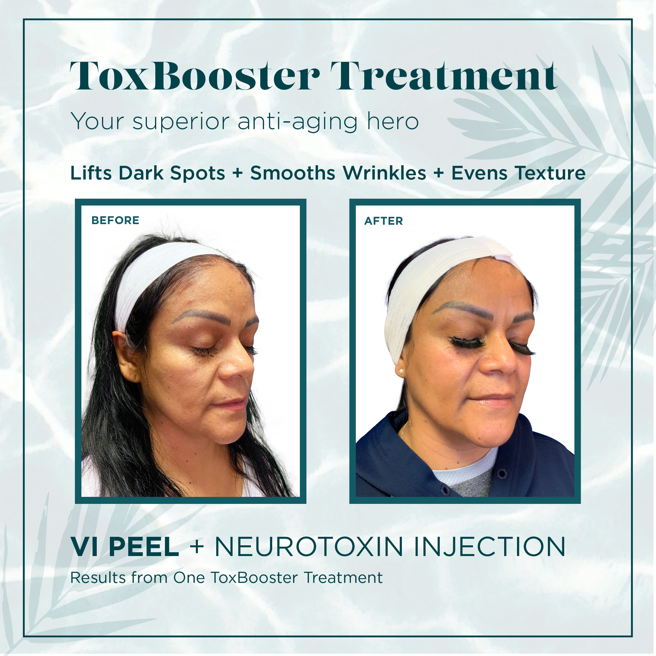 Chemical Peels